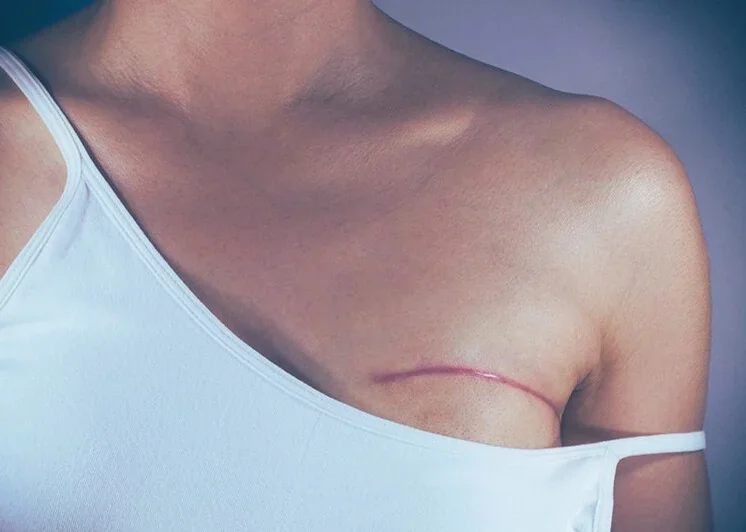 Einfühlsame Brustkrebs-Nachsorge bei Neoscar