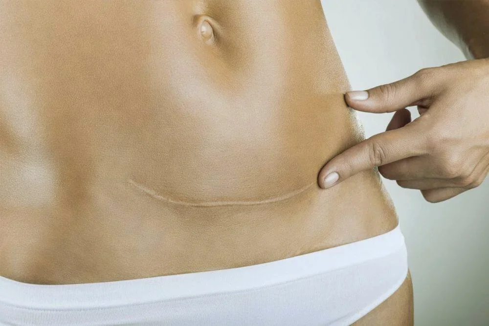 Kaiserschnittnarben-Behandlung bei Neoscar