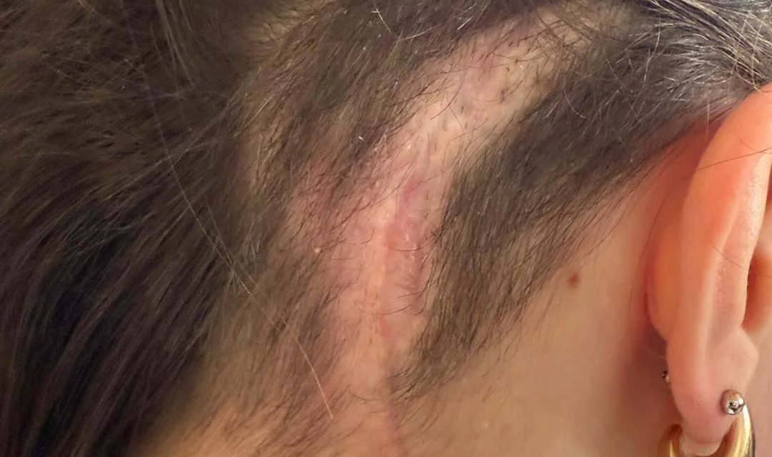 Frau, 22 Jahre alt, Narbenpflege nach Gehirnoperation - Nachher