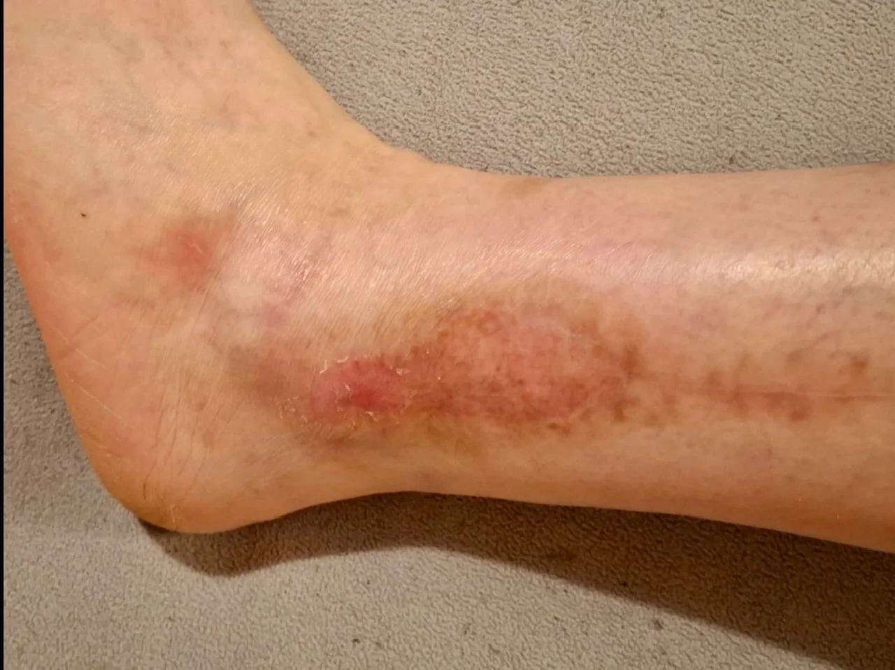 Frau, 54 Jahre alt, 15 Operationen am Fuß, 3 Hauttransplantationen - Nachher