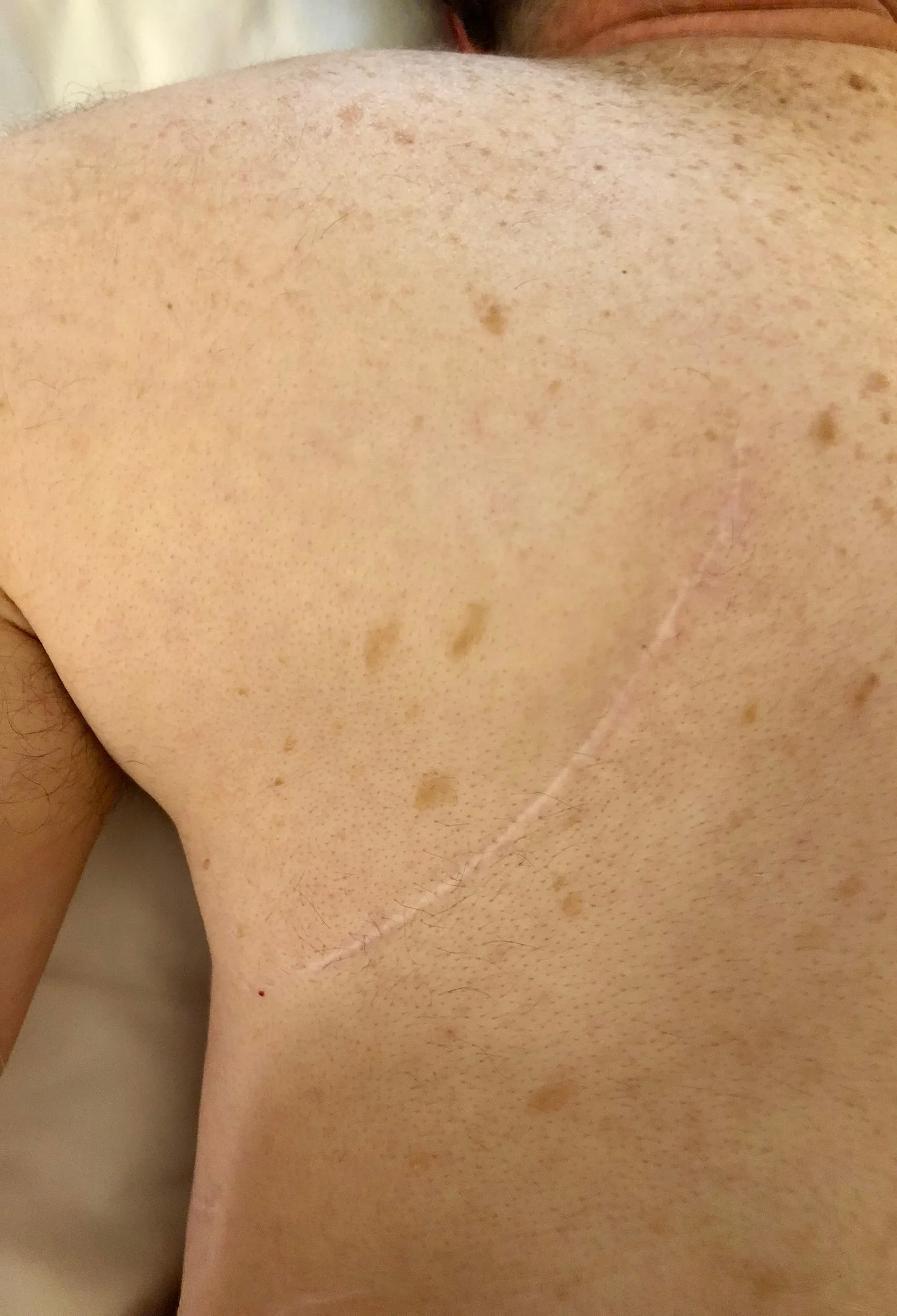 Mann, 65 Jahre alt, Lungentumoroperationen - Nachher